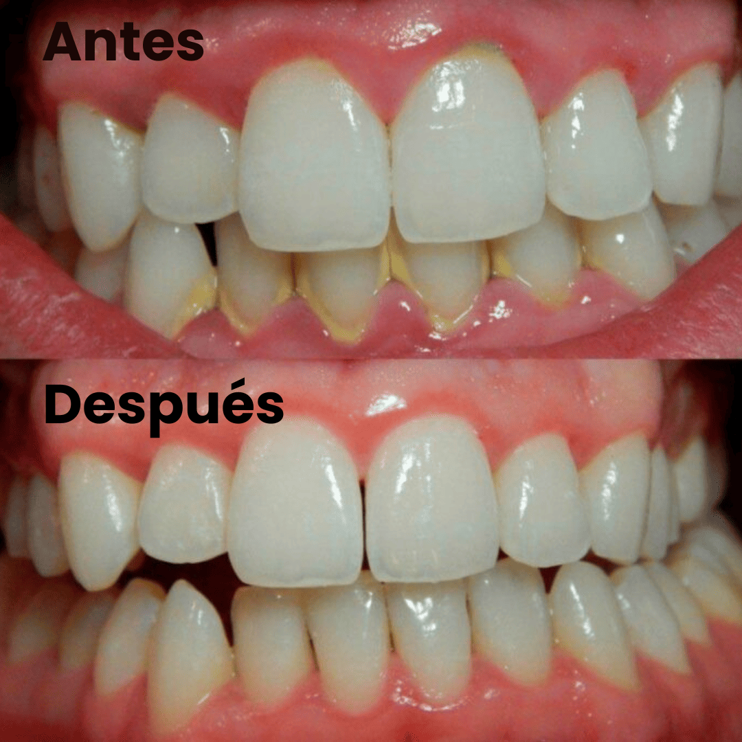 Cepillo De Dientes Quita Sarro